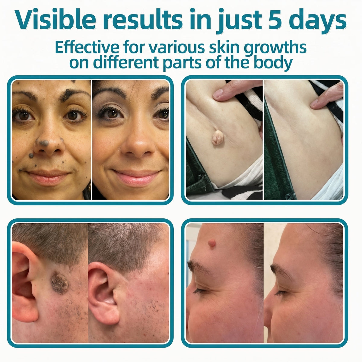 🇺🇸✅𝐇𝐞𝒂𝒍𝗿𝗶𝙯𝙚®2-in-1 Microneedle & Hydrocolloid Patch🔥| Removes Raised Moles, Acne, Flat Warts & Skin Tags | Helps Improve Wrinkles, Scars & Blemishes | Invisible Patches for Face & Body