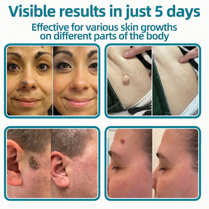🇺🇸✅𝐇𝐞𝒂𝒍𝗿𝗶𝙯𝙚®2-in-1 Microneedle & Hydrocolloid Patch🔥| Removes Raised Moles, Acne, Flat Warts & Skin Tags | Helps Improve Wrinkles, Scars & Blemishes | Invisible Patches for Face & Body