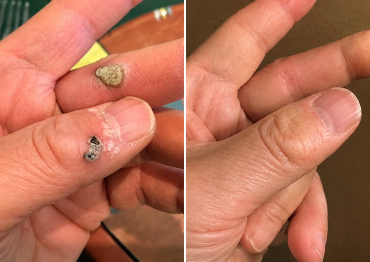 🇺🇸✅𝐇𝐞𝒂𝒍𝗿𝗶𝙯𝙚®2-in-1 Microneedle & Hydrocolloid Patch🔥| Removes Raised Moles, Acne, Flat Warts & Skin Tags | Helps Improve Wrinkles, Scars & Blemishes | Invisible Patches for Face & Body