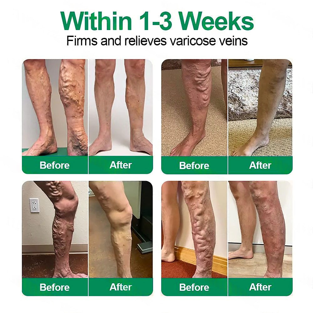 🗽👩‍⚕️👍Healrize® VeinTarget Microneedle Patch⚡Instant Relief, Long-Term Results