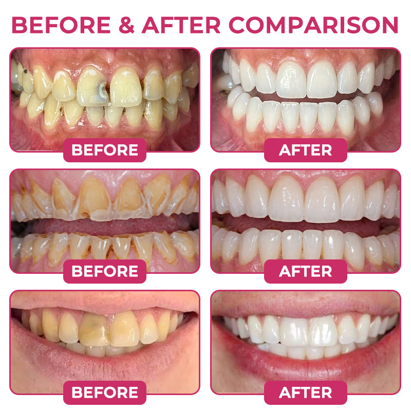 🇺🇸🦷👩‍⚕️CureViVo® DenPerm Cavity-Repair Natural Enamel Filling Gel👍