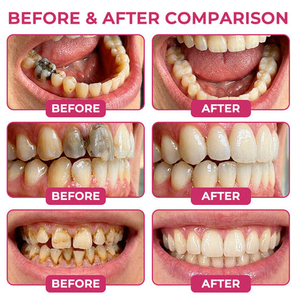 🇺🇸🦷👩‍⚕️CureViVo® DenPerm Cavity-Repair Natural Enamel Filling Gel👍
