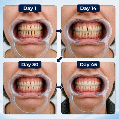 REBYIPO® GumRevive Advanced Dual-Wavelength Gum Care System